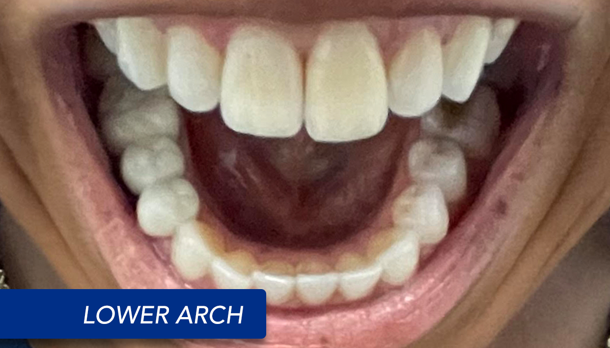 Lower Arch Smile