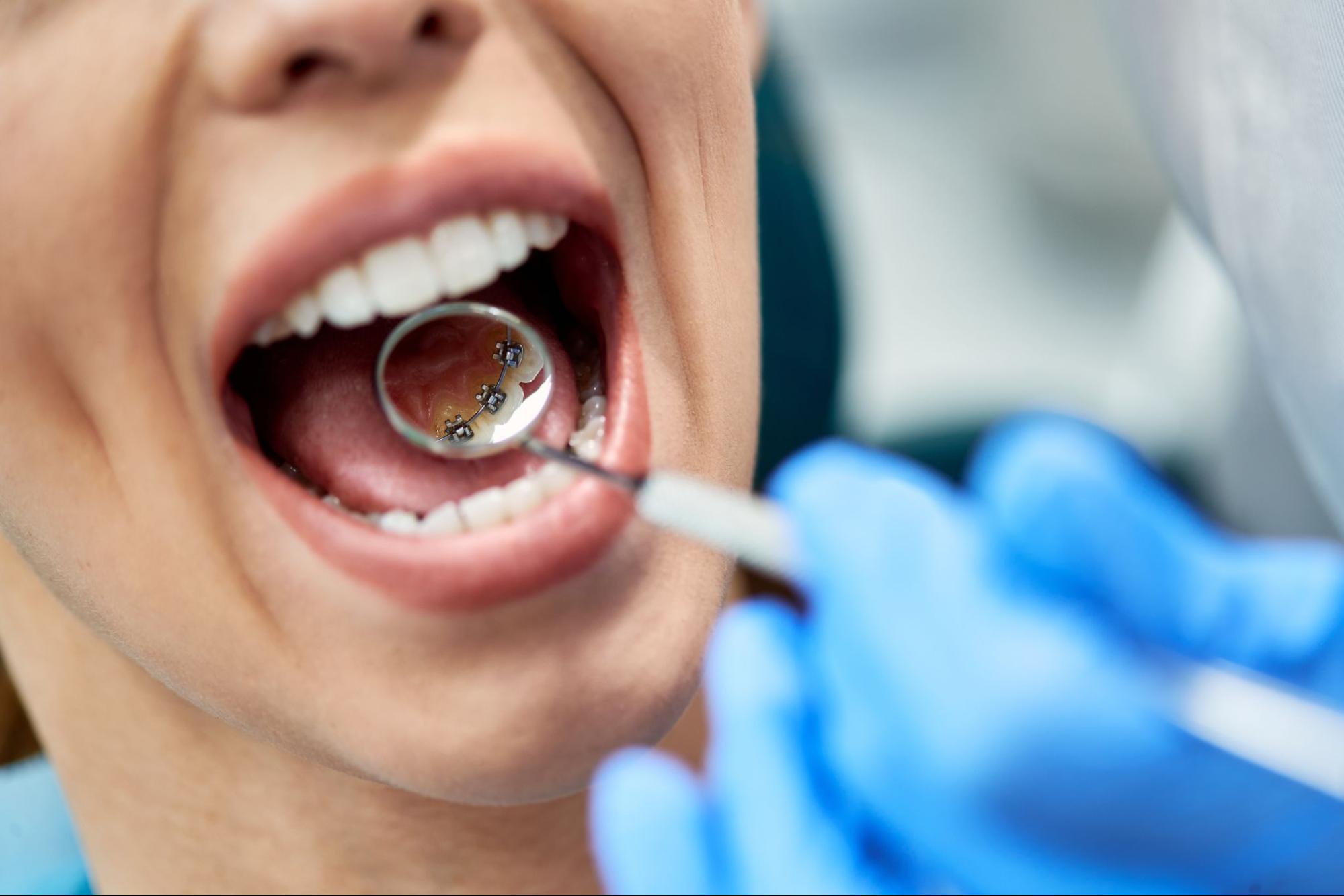 Everything You Need to Know About Lingual Braces