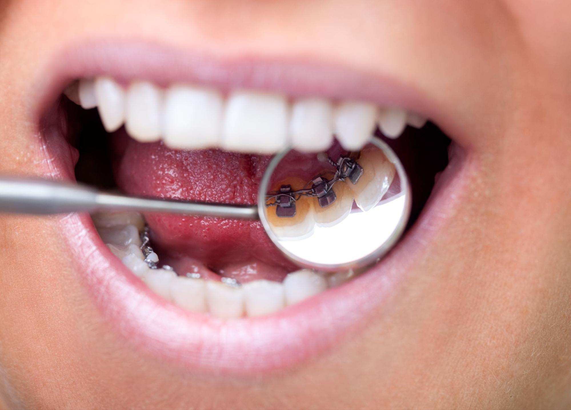 Which Orthodontic Treatment is Right for Me?