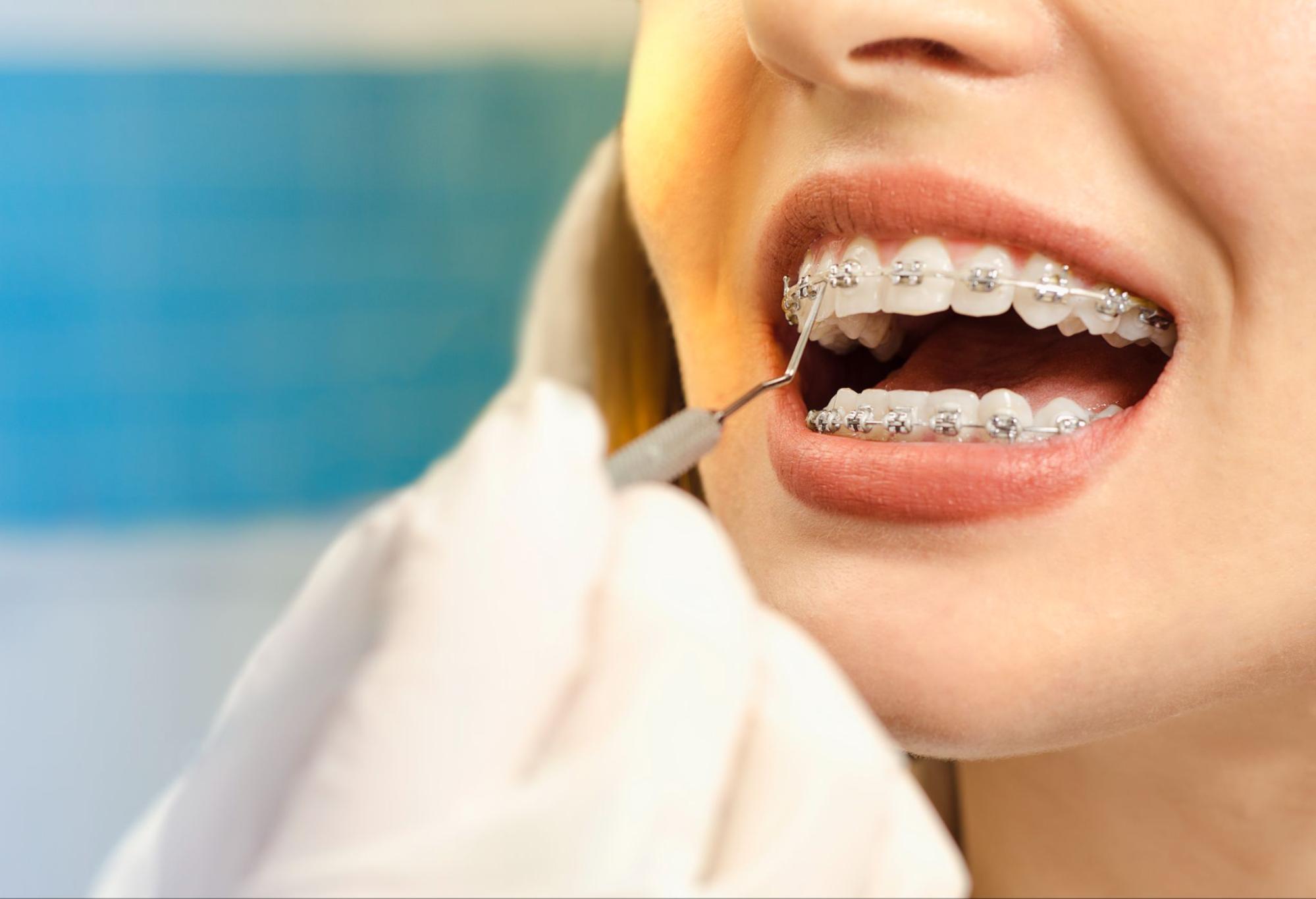 Which Orthodontic Treatment is Right for Me?