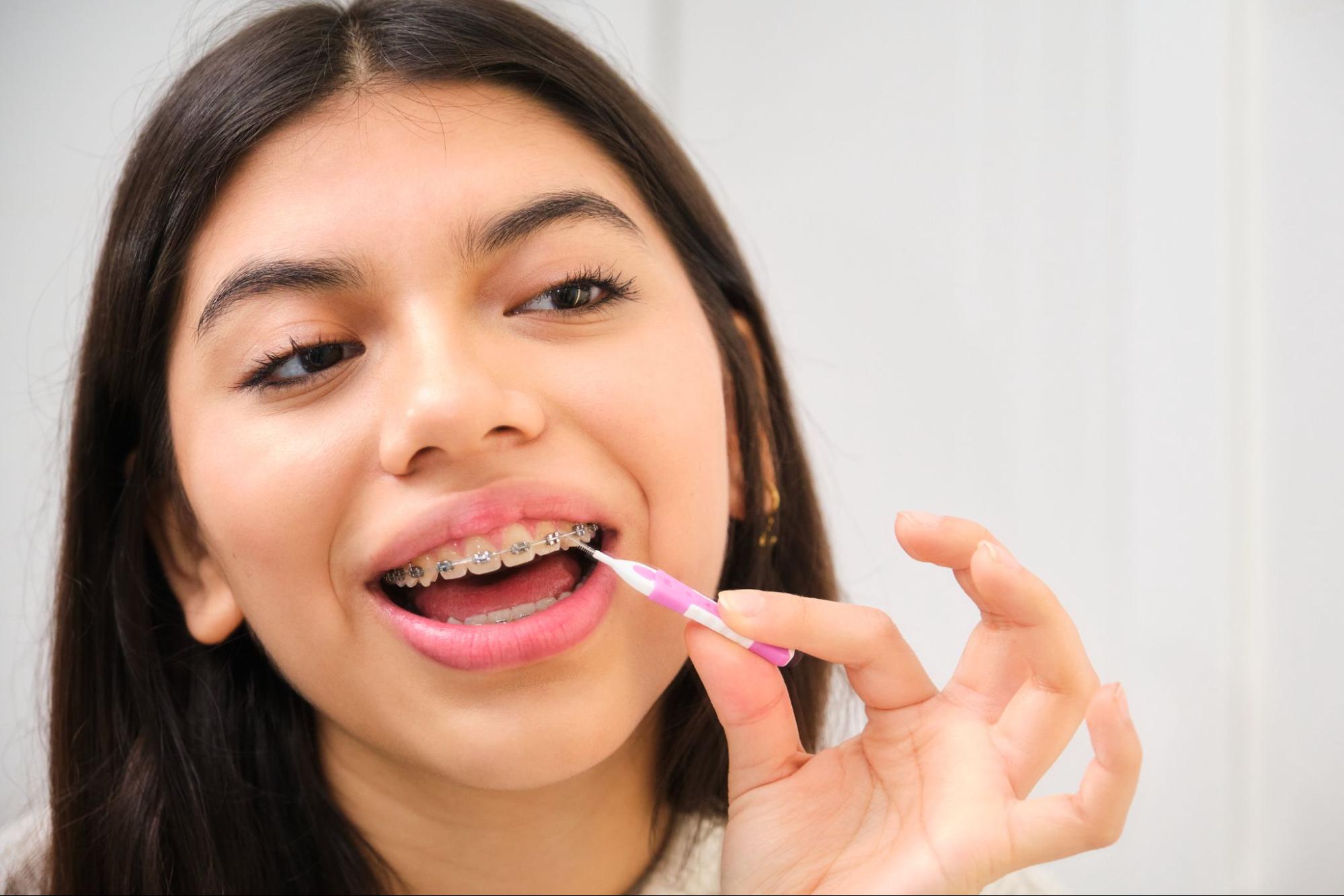 Tips for Keeping Your Braces Clean