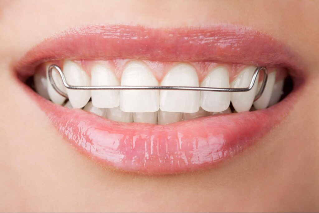 How Orthodontic Retainers Keep East End Smiles on Track