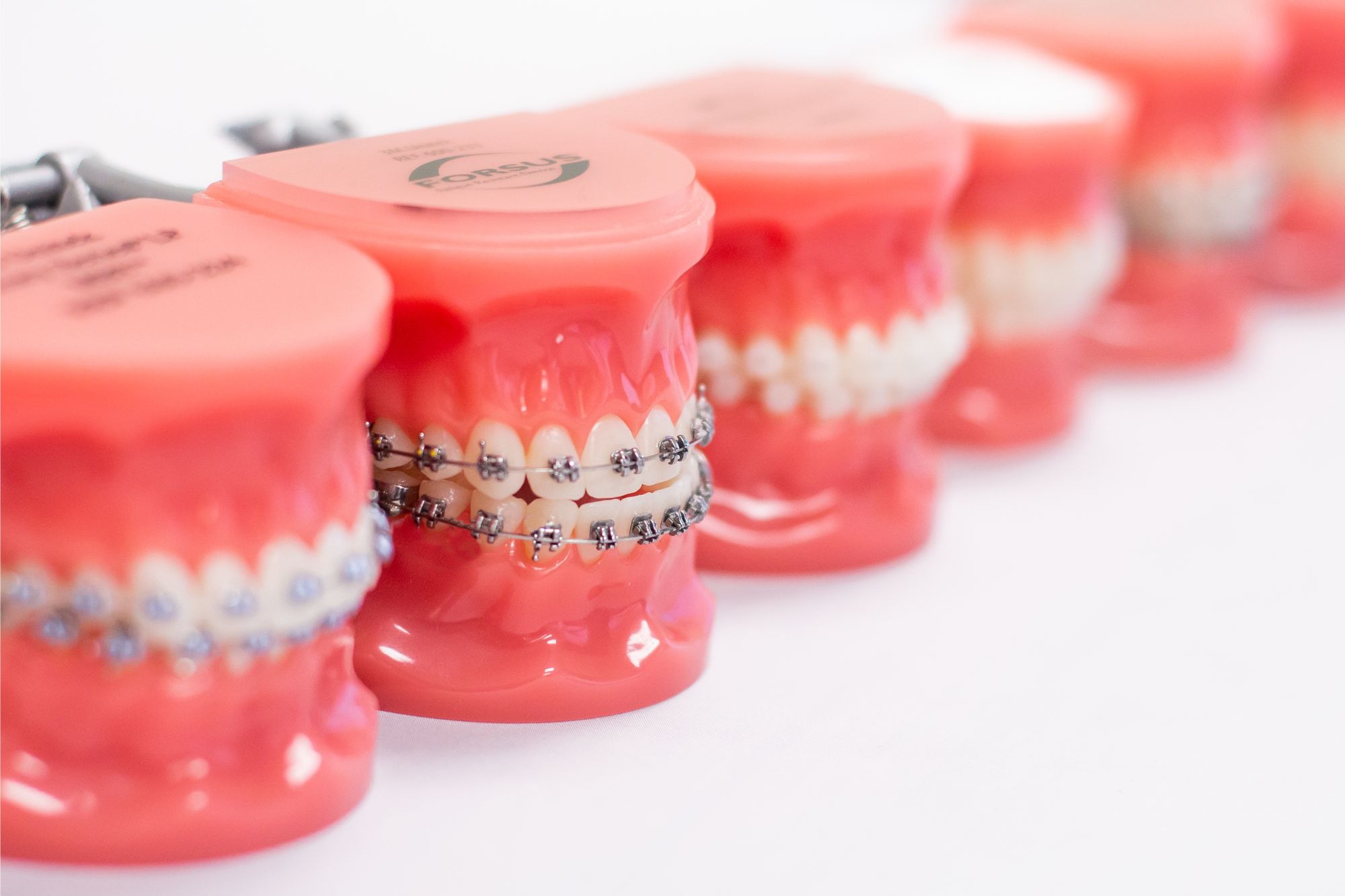 Models of teeth with metal and clear braces demonstrating orthodontic treatment options at Facing the Future Orthodontics in Southampton.